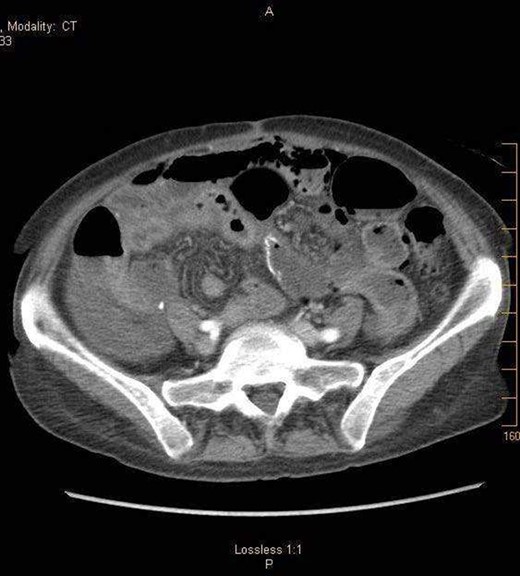 7.4.18:CTAP w/IV and PO contrast: suggestive for small bowel obstruction, distal small bowel collapsed, mild or moderate free air suggestive of perforated viscus, free fluid in dependent portion of pelvis.