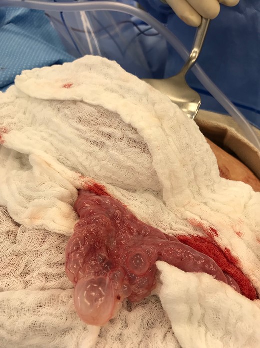 Multiple air filled cystic serosal nodules consistent with pneumatosis cystoides intestinalis.
