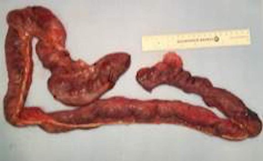 Multiple air filled cystic serosal nodules consistent with pneumatosis cystoides intestinalis.
