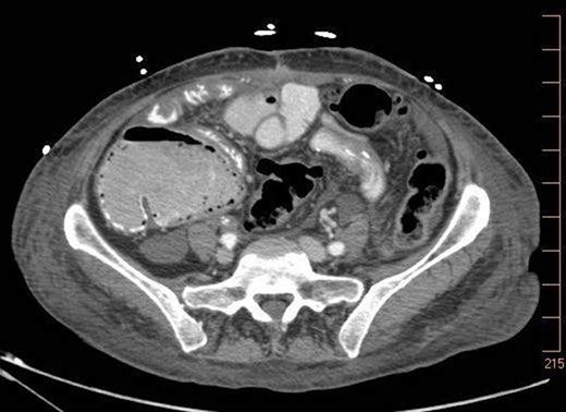 7.9.18: CTAP w/IV and PO contrast: pneumatosis within ascending and transverse colon, no evidence of bowel thickening or fat stranding, no evidence of bowel obstruction.