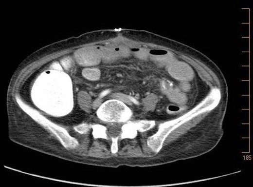 7.14.18: CTAP w/IV and PO contrast: largely resolved pneumatosis.