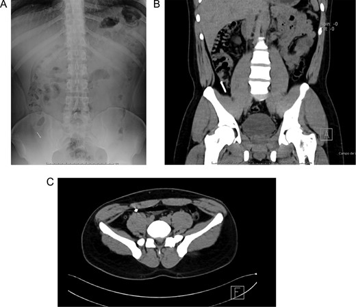 (A) Abdominal X-ray with a radiopaque metallic foreign body. (B) Abdominal CT, the metallic foreign body is lodged in the appendix. (C) Abdominal CT, the appendix is surrounded by homogeneous non-inflamed fat and contains intraluminal air.