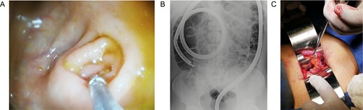 (A) Colonoscopy, the appendiceal orifice is seen without the foreign object. (B) Intraoperative abdominal x-ray confirming the presence of the nail in the appendix. (C) Appendix during surgery.