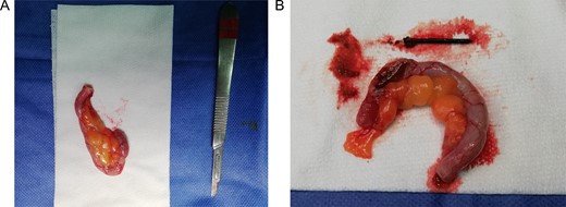 (A) Completely resected appendix. (B) Appendix and metallic nail.