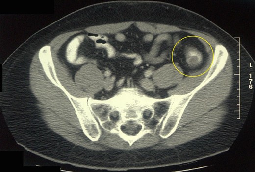 Abdominal CT scan of the patient showing a space-occupying lesion in the distal descending colon.