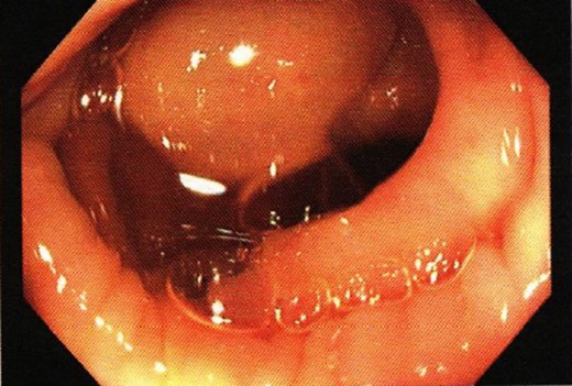 Colonoscopic finding showing a smooth distal descending colon tumour.