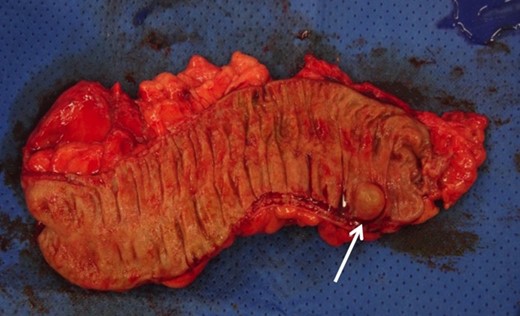 Gross picture of the high anterior resection specimen showing the descending colon lymphangioma.