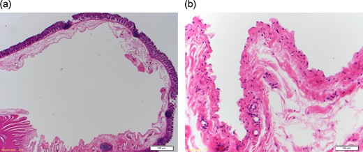 Haematoxylin and eosin stained section ((a) low power magnification, (b) high power magnification) showing a unilocular cyst in the submucosa lined by lymphatic endothelium with a thin fibrous wall containing occasional bundles of smooth muscle. Some smaller adjacent lymphatic channels are noted at high power.