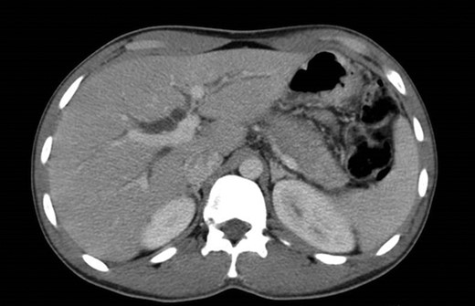 Pancreatic CT scan. General dilatation of the intrahepatic biliary tree and terminal common bile duct.