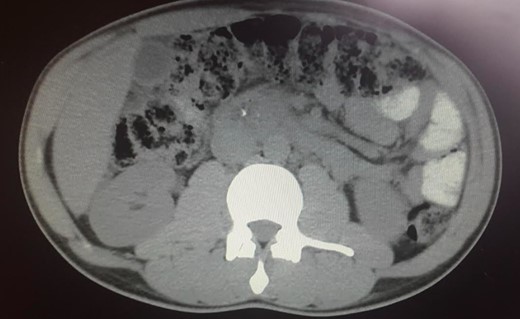 Pancreatic CT scan. Dilatation of the distal bile duct, with no evidence of luminal lesions nor a pancreatic mass constricting the bile duct (endoluminal prosthesis).