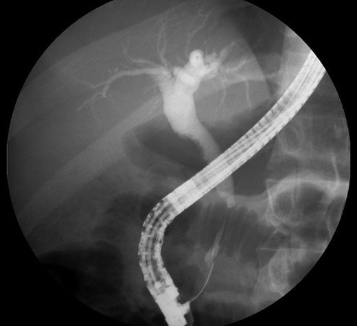 ERCP. Heterogeneous pancreatic parenchyma and pseudonodular appearance of the pancreatic head. Wirsung duct with no stenosis or obstructions. Common bile duct with normal caliber until the intrapancreatic portion where a highly suspicious of malignancy 2 cm irregular stenosis is seen.