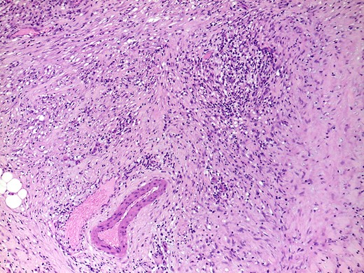 H&E, ×100. Parenchymal fibrosis with focal storiform-type areas and a lymphoplasmacytic infiltrate, that focally involves a vein, without overt obliterative phlebitis.