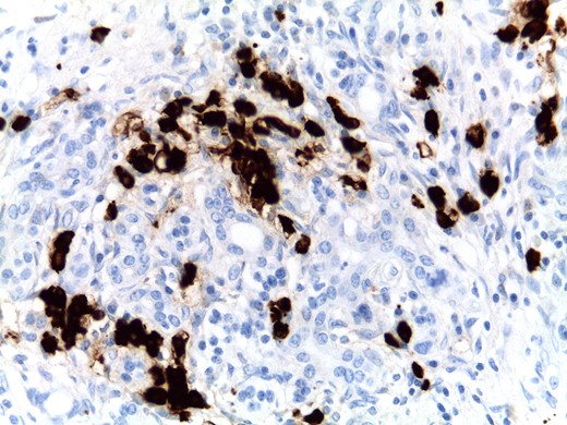 Focal areas with more than 50 IgG4+ plasma cells per high-power field were found, although a diffuse infiltrate was not present in this case.