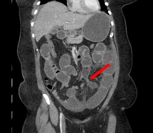 Coronal view: arrow pointing to the dumb-bell transition point, where the proximal end of the closed loop small bowel herniated through a hole in the sigmoid epiploica.