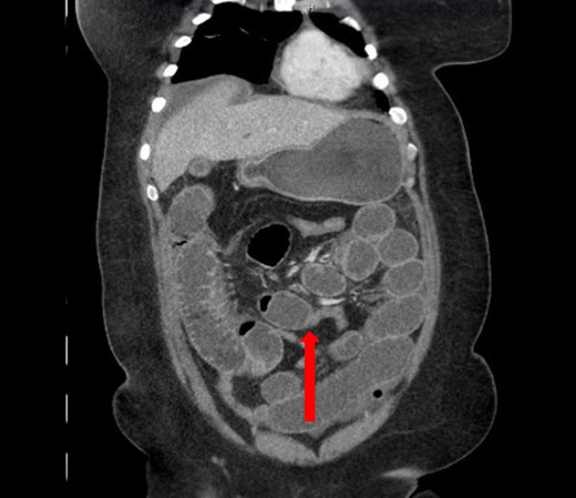 Coronal view: arrow pointing to the sharp transition point, where the distal end of the closed loop small bowel herniated through a hole in the sigmoid epiploica, demonstrating collapsed small bowel distally.