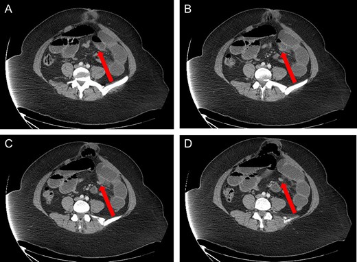 Axial view: (A) and (B) arrows pointing to dilated small bowel from the closed loop obstruction. (C) and (D) arrows pointing to the transition point, where the small bowel is collapsed distally.
