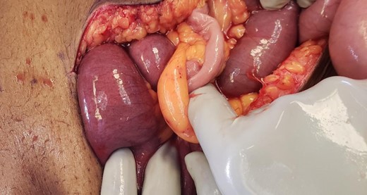 Intra-operative photo with index finger placed in the hole of the sigmoid epiploica, the site where small bowel is herniating through.
