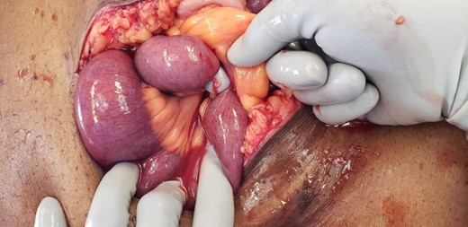 Intra-operative photo, second view, with index finger placed in the hole of the sigmoid epiploica, demonstrating the closed loop of small bowel.