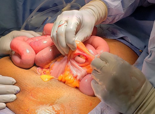 Intra-operative photo, status-post reduction of internal hernia. The defect in the sigmoid epiploica is approximately 2 cm in diameter.