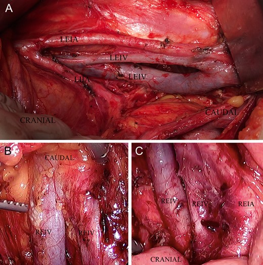 (A) shows a duplication of the left external iliac vein throughout its length, (B) shows a caudal duplication of the right external iliac vein and (C) shows a cranial duplication of the right external iliac vein.
