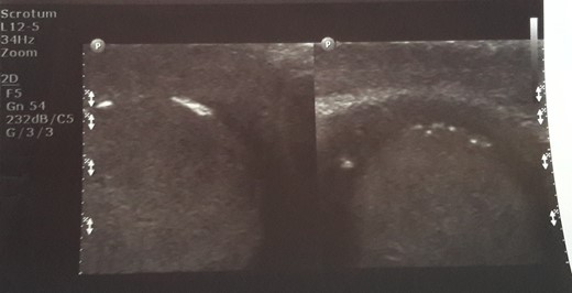 Initial sonographic findings were suggestive of orheoepididymitis.