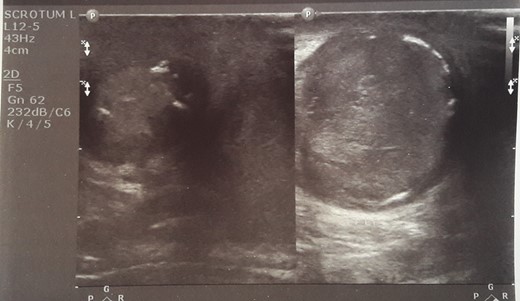 Five days later another ultrasound showed reduced testicular perfusion that reached only the periphery of the testicular parenchyma.