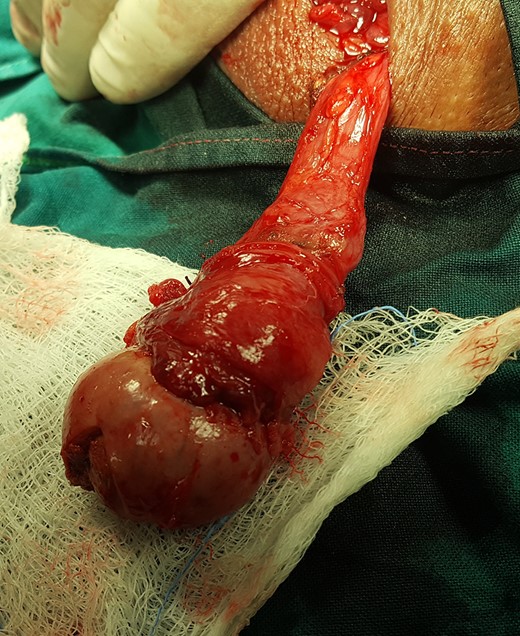 Intraoperatively testis was non-twisted, with normal vas and vessels that ended in a necrotic testicular parenchyma.