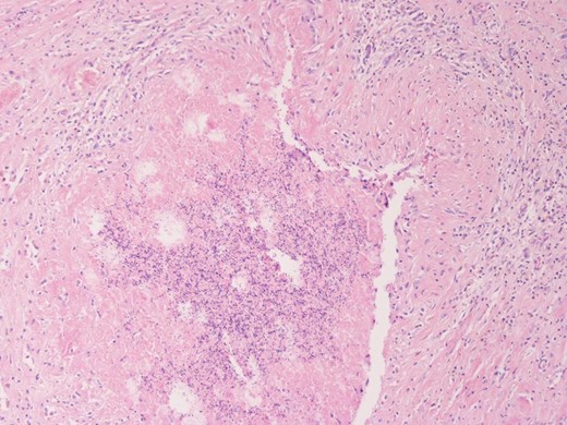Spermatic granuloma: accumulation of sperm (center) surrounded by a granulomatous foreign body inflammatory response (upper part). H-EX 100.