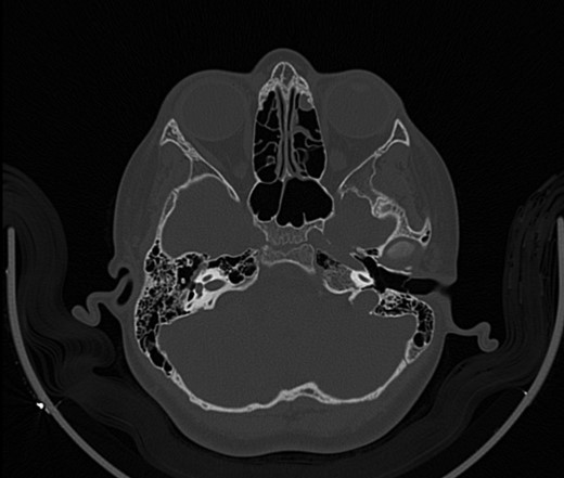 CT mastoid, deranged right side ossicular disruption.