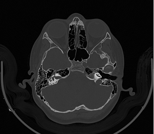 CT mastoid, deranged right side ossicular disruption.