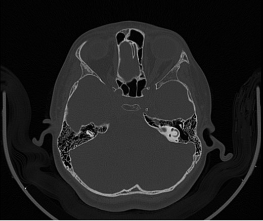 CT mastoid, deranged left side ossicular disruption.