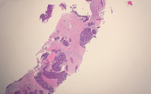 Microscopic examination from an ultrasound guided core-needle biopsy from the 7–8 o'clock retro-areolar region shows tumor composed of both luminal and basal cells (small bland myoepithelial cells with scant cytoplasm and dark compact angular nuclei surround pseudoglandular spaces with mucin).