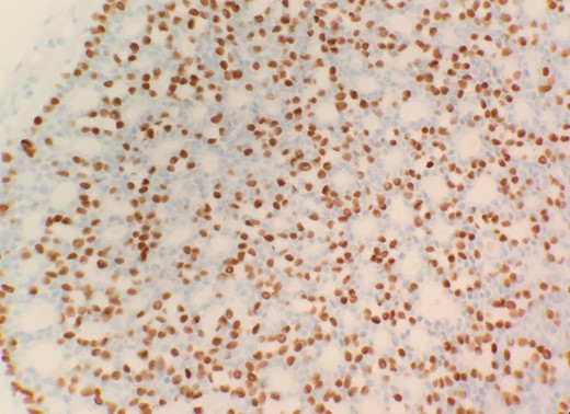 Immunohistochemical stain p63 positive for basal cells.