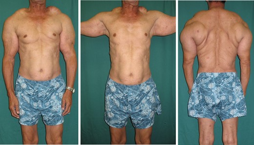 Preoperative physical examination (61 years old: body weight 63 kg). Symmetrical, painless, bulging soft masses were seen on the posterior neck, shoulders, upper arms, chest and back.