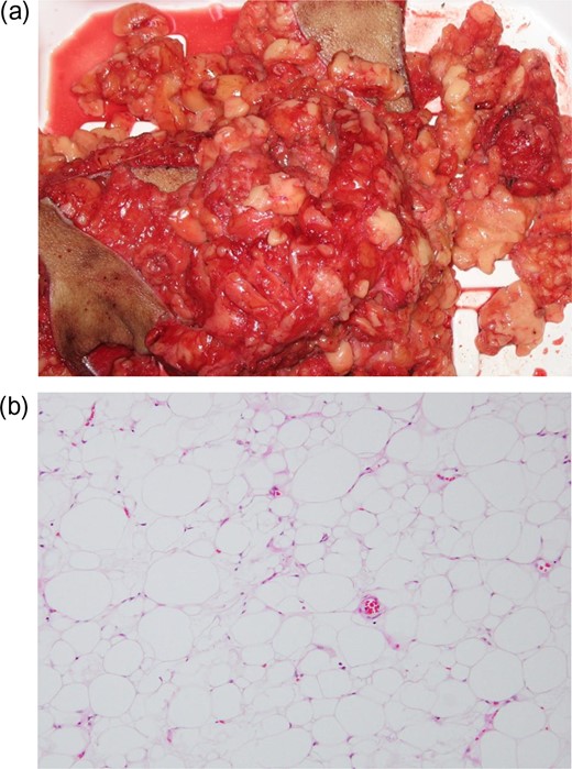 (a) Resected fatty masses. The adipose tissue was white, slightly large, uniform in size and brittle. (b) Histopathological findings (hematoxylin and eosin staining, original magnification ×100). Histopathological examination showed relatively small adipose cells with a slight increase in vascular elements without malignancy.