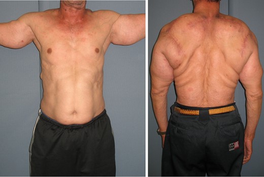 Postoperative physical examination (63 years old, 3 months after third lipectomy: body weight 70 kg). The lesions on both shoulders, upper arms and back were reduced. Postoperative wounds were less remarkable.