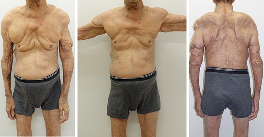 Postoperative physical examination (73 years old, 12 years after initial surgery: body weight 55 kg) There were no changes in size of the lesions themselves, but skin relaxation was remarkable.