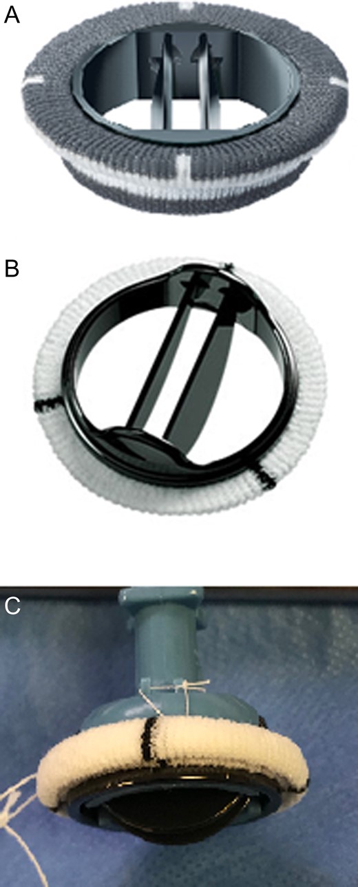 Carbomedics mechanical mitral valve (A) and St. Jude mechanical mitral valve (B) and (C).