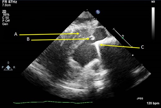 Oblique parasternal long axis TTE image showing thickened IVS (A), subaortic fibrous material (B) and the protruding mitral valve prosthesis (C).