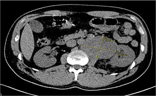 Urotomography scan with evidence of a retroperitoneal mass that displaces the left kidney with hydronephrosis. The calculated volume was 10 × 8 × 6 cm3.