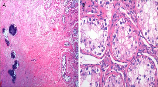 Spontaneous tumor regression in testis. Hematoxylin and eosin (H&E) stain. (A) Pathology results showed subtotal atrophy of the testis with extensive fibrosis, multifocal calcifications, focal hemorrhage and Leydig’s cell hyperplasia. (B) Absent spermatogenesis in seminiferous tubules. Intratubular germ cells with clear cytoplasm.