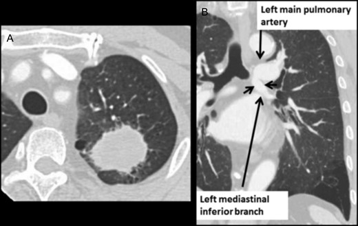 (A) Chest CT shows lung mass in the left upper lobe. (B) Chest contrast-enhanced CT shows the mediastinal anomalous inferior lobar branch.