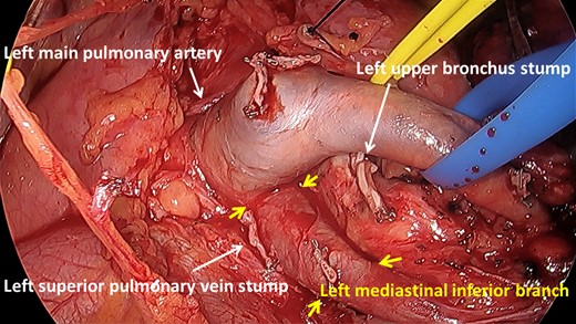 Aberrant mediastinal trunk of the pulmonary artery (A5+A8+A9b) arose from the left main pulmonary artery and ran in front of the bronchus.