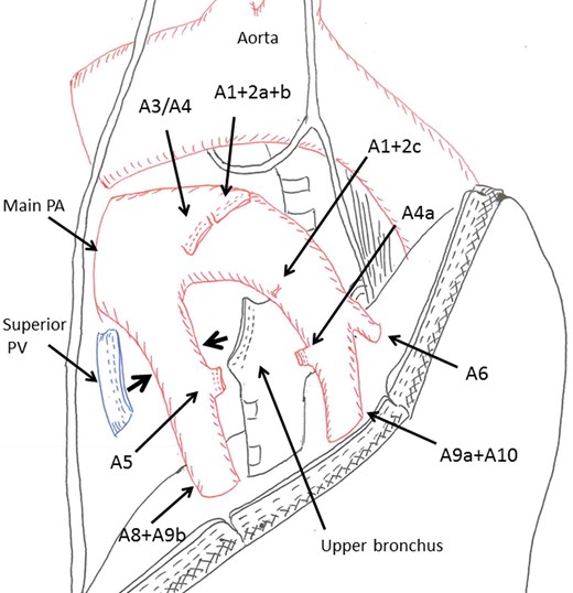 Schema illustrates the relative position of the pulmonary hilum and the mediastinal lingular and basal branches.