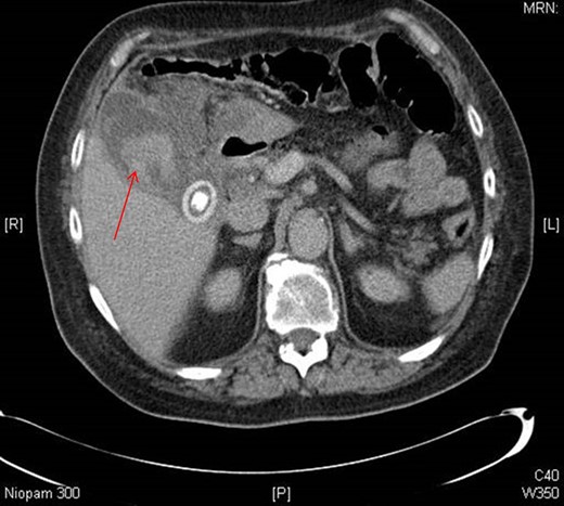 Axial view of CT abdomen showing haemorrhagic cholecystitis.