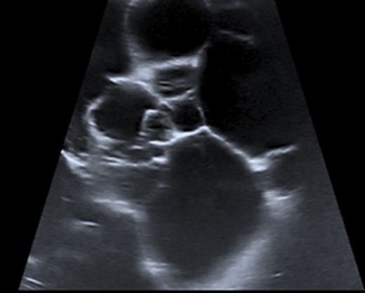 Ultrasonography of paratesticular lesion showing hyperechoic cystic regions with multiple septations.