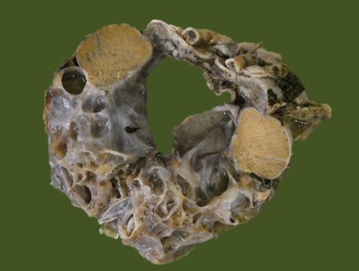 Multicystic surgical specimen received for examination.