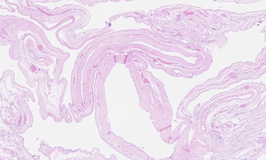 Haematoxylin and eosin staining showing thin-walled cystic areas lined by cuboidal mesothelial cells.