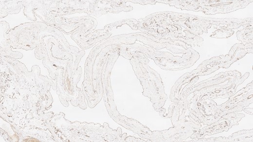 WT-1 immunohistochemical staining.