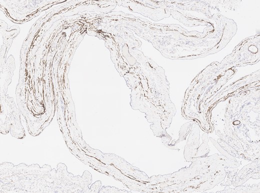 Calretinin immunohistochemical staining.
